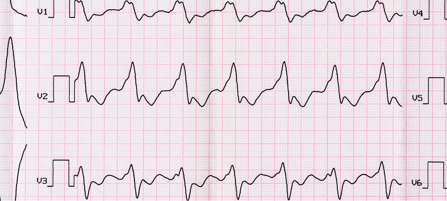 Atriumfibrilleren